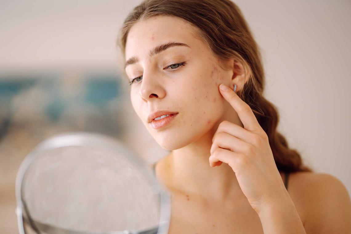 Bildnachweis: © stock.adobe.com / maxbelchenko Junge Frau mit Hautproblemen betrachtet ihr Gesicht im Spiegel